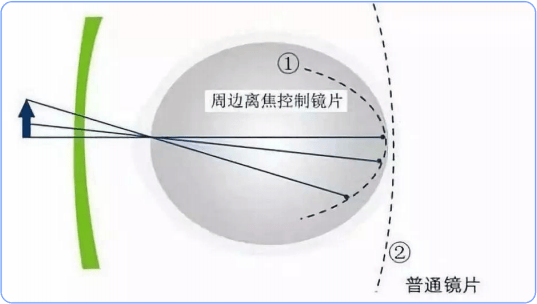 防控近視的離焦眼鏡有用嗎？